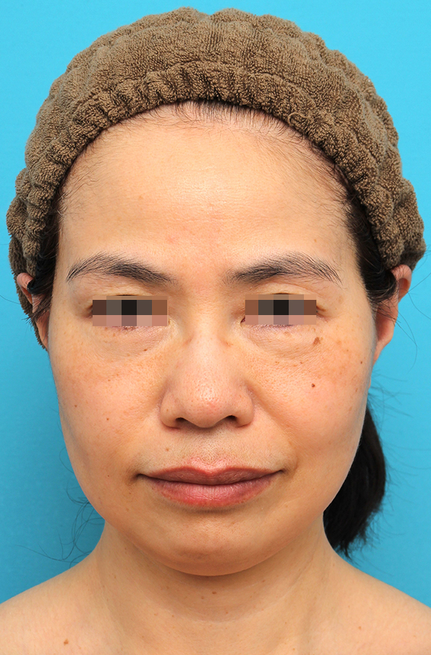 ミディアムフェイスリフト,ミディアムフェイスリフトを行った50代女性の症例写真,3週間後,mainpic_mediumlift025d.jpg