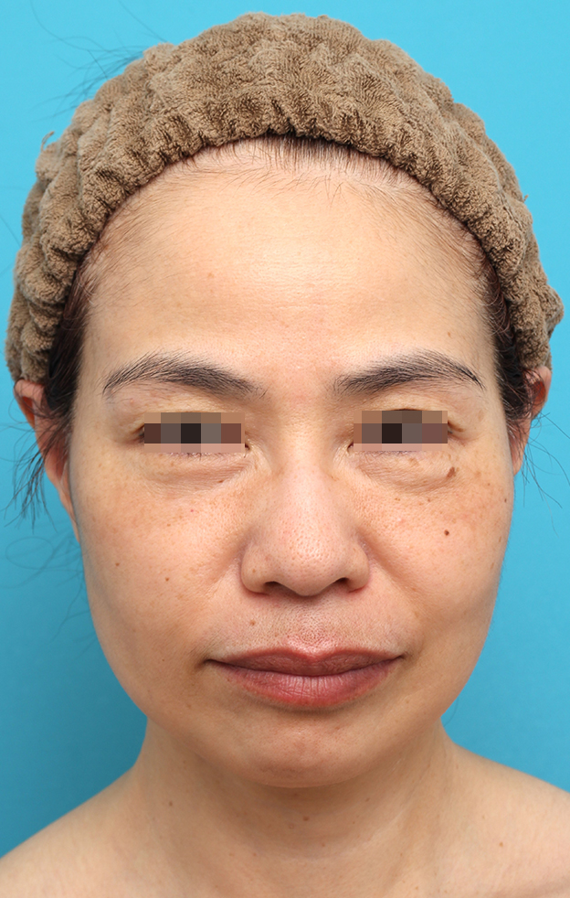 ミディアムフェイスリフト,ミディアムフェイスリフトを行った50代女性の症例写真,2ヶ月後,mainpic_mediumlift025e.jpg