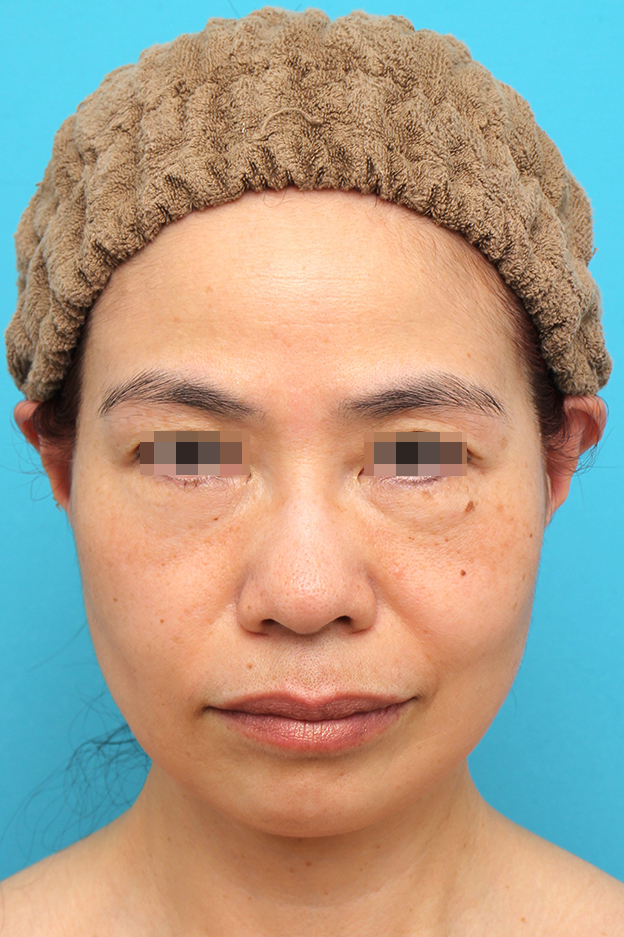 ミディアムフェイスリフト,ミディアムフェイスリフトを行った50代女性の症例写真,6ヶ月後,mainpic_mediumlift025f.jpg