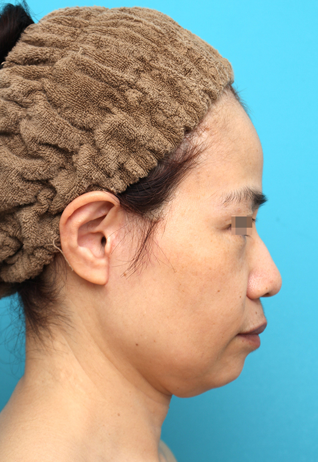 ミディアムフェイスリフト,ミディアムフェイスリフトを行った50代女性の症例写真,2ヶ月後,mainpic_mediumlift025k.jpg