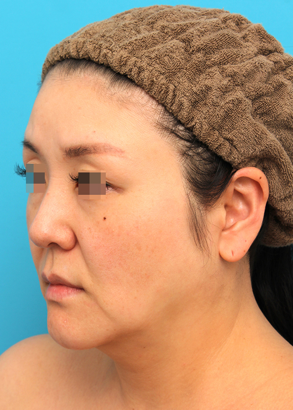 ミディアムフェイスリフト,ミディアムフェイスリフトを行った40代女性症例写真,Before,ba_mediumlift026_b02.jpg