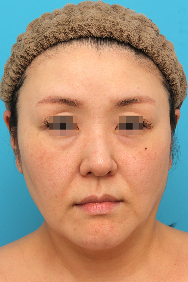 ミディアムフェイスリフト,ミディアムフェイスリフトを行った40代女性症例写真,手術前,mainpic_mediumlift026a.jpg