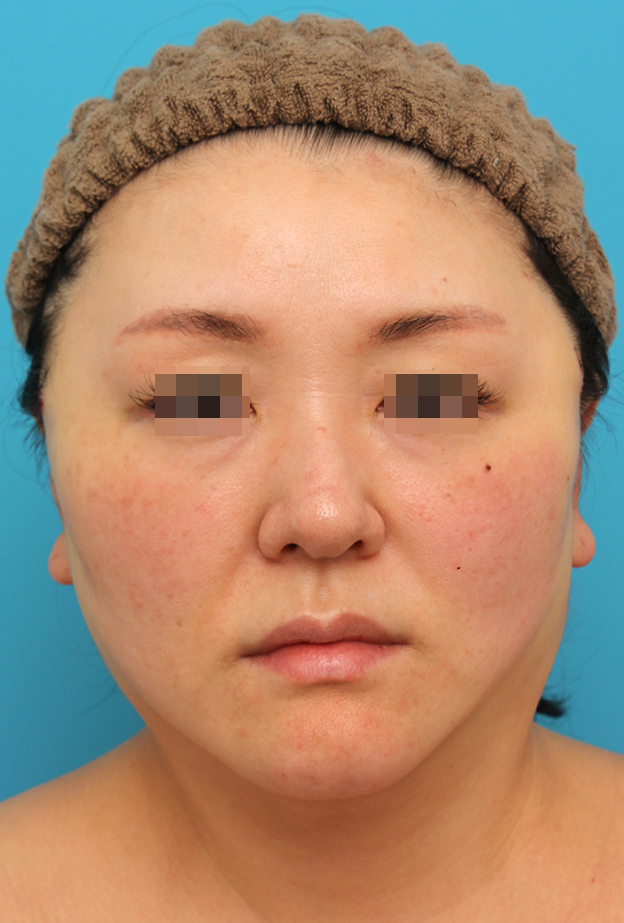 ミディアムフェイスリフト,ミディアムフェイスリフトを行った40代女性症例写真,手術直後,mainpic_mediumlift026b.jpg