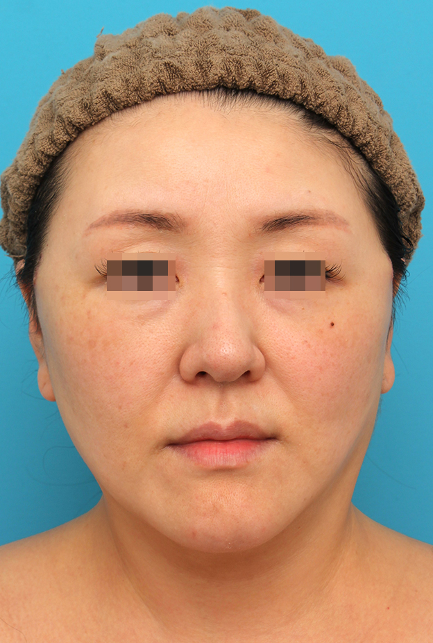 ミディアムフェイスリフト,ミディアムフェイスリフトを行った40代女性症例写真,1週間後,mainpic_mediumlift026c.jpg