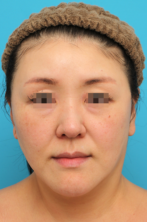 ミディアムフェイスリフト,ミディアムフェイスリフトを行った40代女性症例写真,4ヶ月後,mainpic_mediumlift026d.jpg
