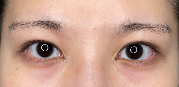 目頭切開で蒙古ひだを切除した症例写真,After（6ヶ月後）,ba_megashira066_a01.jpg