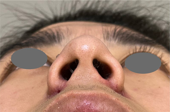 症例写真,鼻翼縮小の内外側法で手術を行った症例写真,After(1週間後),ba_biyoku059_b03.jpg