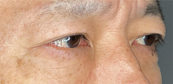 症例写真,目の下の切らない脂肪取りを行い、目の下のふくらみをほぼ無くした症例写真,After(1ヶ月後),ba_shibo_under015_b02.jpg