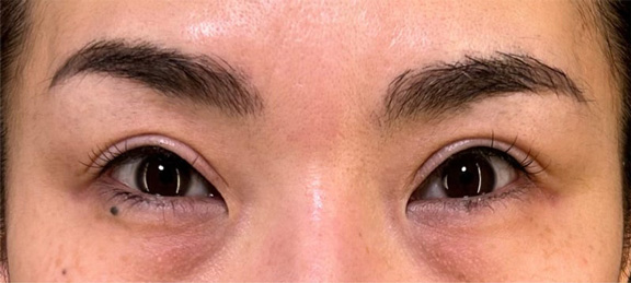 上まぶたたるみ取り,他院の眼瞼下垂手術後の皮膚のかぶさりを上まぶたたるみ取りで修正した症例写真,After(6ヶ月後),ba_tarumi018_b02.jpg