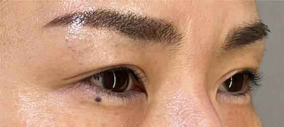 上まぶたたるみ取り,他院で受けた手術の修正（二重まぶた・目もと）,他院の眼瞼下垂手術後の皮膚のかぶさりを上まぶたたるみ取りで修正した症例写真,Before,ba_tarumi018_b01.jpg