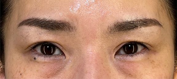 上まぶたたるみ取り,他院の眼瞼下垂手術後の皮膚のかぶさりを上まぶたたるみ取りで修正した症例写真,Before,ba_tarumi018_b02.jpg