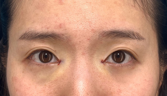 症例写真,目頭切開で離れ目を改善させた20代女性の症例写真,手術直後,mainpic_megashira067b.jpg