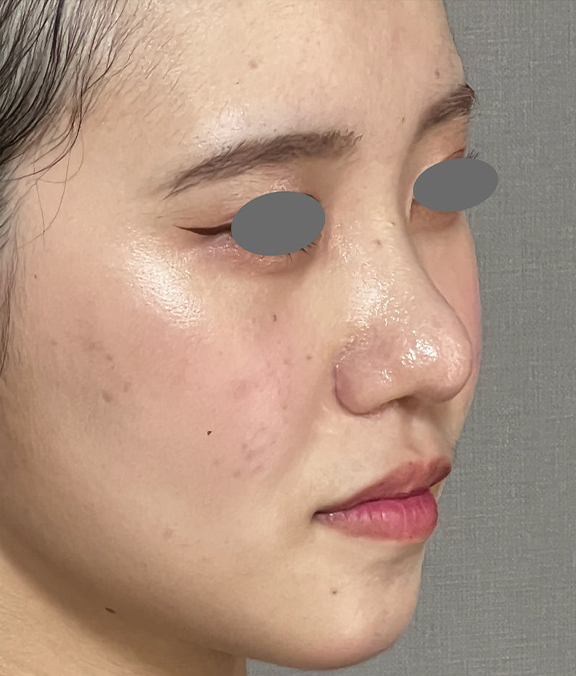 鼻尖形成(鼻尖縮小・だんご鼻修正),小鼻縮小、耳介軟骨移植、鼻尖形成を同時に行った症例写真,After(3ヶ月後),ba_biyoku060_b02.jpg
