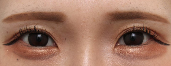 症例写真,二重幅を変えずに二重ラインを安定させた症例写真,After(メイクあり)<br/>
(1ヶ月後),