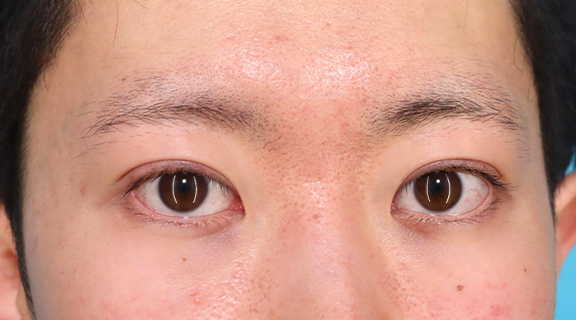 二重まぶた・全切開法,二重まぶた全切開法で自然な末広型二重にした20代男性の症例写真,After（2ヶ月後）,ba_sekkai104_a01.jpg