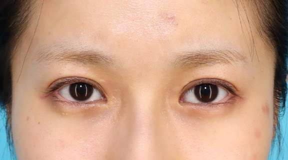 二重まぶた・全切開法,二重まぶた全切開法で平行型二重にした20代女性の症例写真,After（6ヶ月後）,ba_sekkai105_a01.jpg