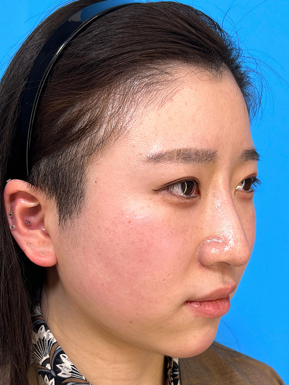 耳介軟骨移植(鼻先を出す),鼻筋のシリコンプロテーゼ+鼻先の耳介軟骨移植+小鼻縮小を行った20代女性の症例写真,After(3ヶ月後),ba_ryubi1066_b02.jpg