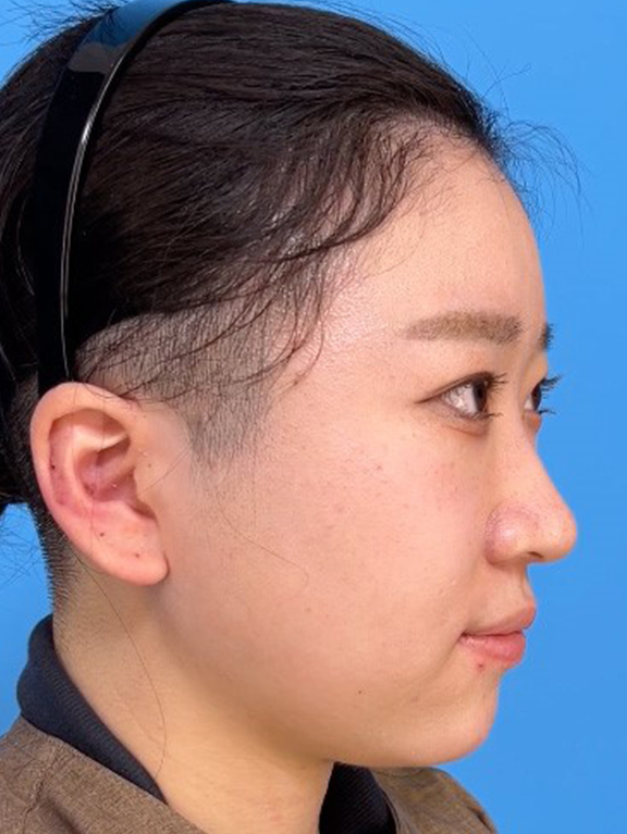 耳介軟骨移植(鼻先を出す),鼻筋のシリコンプロテーゼ+鼻先の耳介軟骨移植+小鼻縮小を行った20代女性の症例写真,Before,ba_ryubi1066_b02.jpg