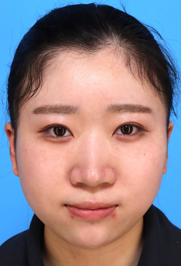 耳介軟骨移植(鼻先を出す),鼻筋のシリコンプロテーゼ+鼻先の耳介軟骨移植+小鼻縮小を行った20代女性の症例写真,手術前,mainpic_ryubi1066a.jpg