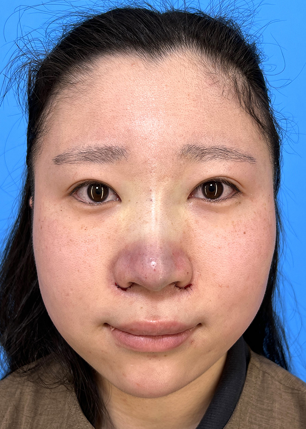 耳介軟骨移植(鼻先を出す),鼻筋のシリコンプロテーゼ+鼻先の耳介軟骨移植+小鼻縮小を行った20代女性の症例写真,手術直後,mainpic_ryubi1066b.jpg