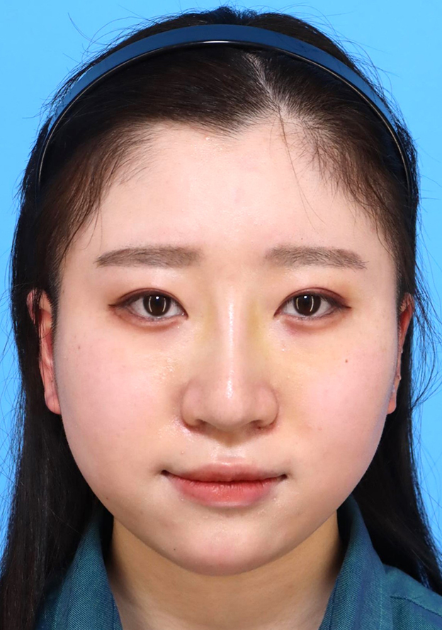 耳介軟骨移植(鼻先を出す),鼻筋のシリコンプロテーゼ+鼻先の耳介軟骨移植+小鼻縮小を行った20代女性の症例写真,1週間後,mainpic_ryubi1066c.jpg