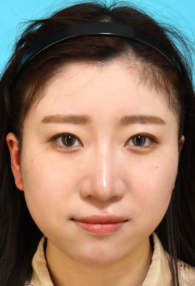 耳介軟骨移植(鼻先を出す),鼻筋のシリコンプロテーゼ+鼻先の耳介軟骨移植+小鼻縮小を行った20代女性の症例写真,3ヶ月後,mainpic_ryubi1066d.jpg