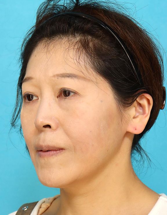 症例写真,鼻翼基部プロテーゼ(貴族手術)で中顔面の陥没を改善し、法令線が浅くなった症例写真,After(6ヶ月後),ba_biyokukibu001_b02.jpg