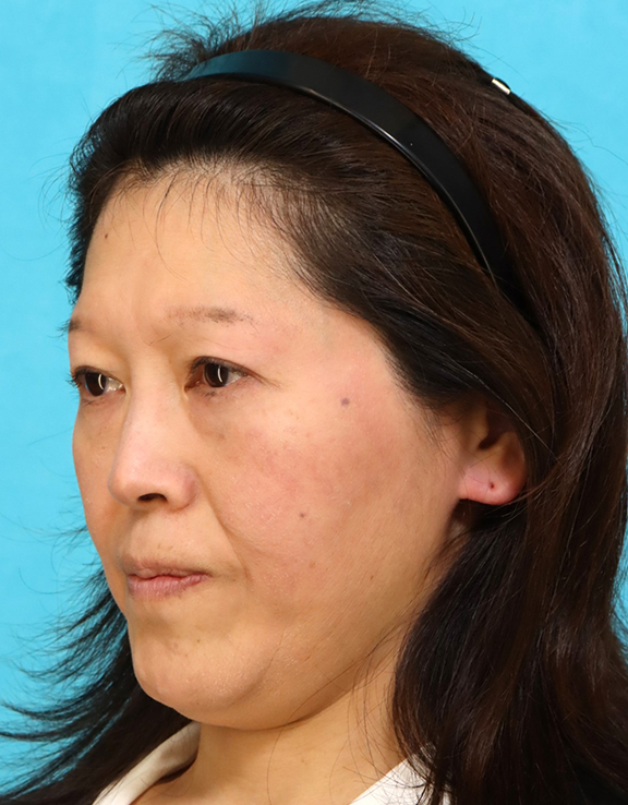 症例写真,鼻翼基部プロテーゼ(貴族手術)で中顔面の陥没を改善し、法令線が浅くなった症例写真,Before,ba_biyokukibu001_b02.jpg