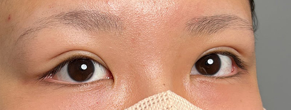 二重まぶた・連続埋没法,10代女性に連続埋没法で二重を作った症例写真,After(1ヶ月後),ba_maibotsu3002_b02.jpg
