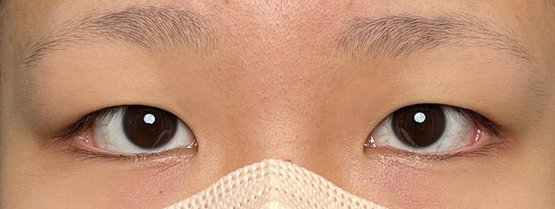 二重まぶた・連続埋没法,10代女性に連続埋没法で二重を作った症例写真,施術前,mainpic_maibotsu3002a.jpg