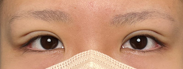 二重まぶた・連続埋没法,10代女性に連続埋没法で二重を作った症例写真,施術直後,mainpic_maibotsu3002b.jpg