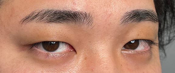 二重まぶた・連続埋没法,連続埋没法で二重を作った男性の症例写真,Before,ba_maibotsu3003_b02.jpg