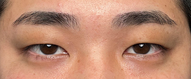 二重まぶた・連続埋没法,連続埋没法で二重を作った男性の症例写真,施術前,mainpic_maibotsu3003a.jpg