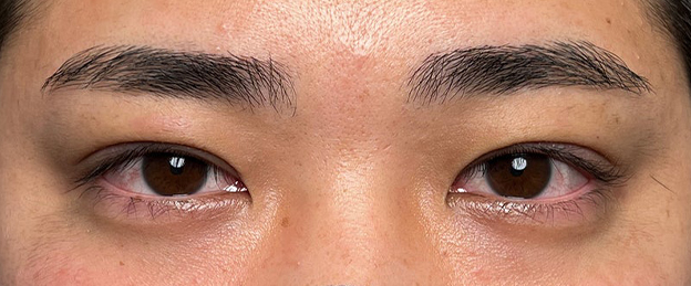 二重まぶた・連続埋没法,連続埋没法で二重を作った男性の症例写真,施術直後,mainpic_maibotsu3003b.jpg