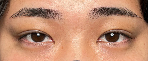 二重まぶた・連続埋没法,連続埋没法で二重を作った男性の症例写真,1ヶ月後,mainpic_maibotsu3003c.jpg