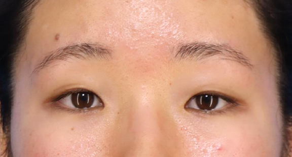 二重まぶた・埋没法,埋没法二針固定で自然な末広型二重を作った20代女性の症例写真,Before,ba_maibotsu081_b01.jpg