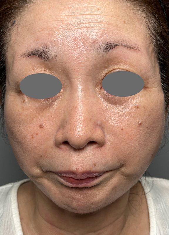 ミニフェイスリフト（頬のたるみ取り）,ミニ切開リフトを行った症例写真,After（6ヶ月後）,ba_minilift022_a01.jpg