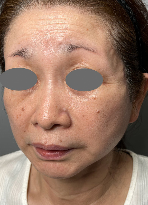 ミニフェイスリフト(頬のたるみ取り),ミニ切開リフトを行った症例写真,After(6ヶ月後),ba_minilift022_b02.jpg