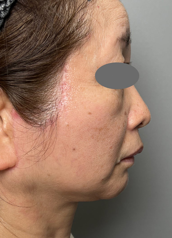 ミニフェイスリフト(頬のたるみ取り),ミニ切開リフトを行った症例写真,After(6ヶ月後),ba_minilift022_b03.jpg