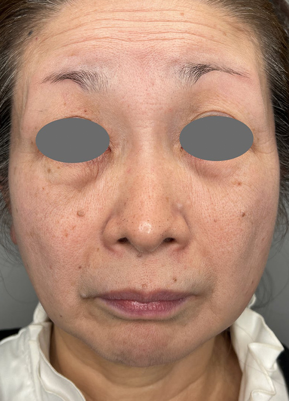 ミニフェイスリフト（頬のたるみ取り）,ミニ切開リフトを行った症例写真,Before,ba_minilift022_b01.jpg