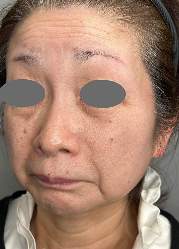 ミニフェイスリフト(頬のたるみ取り),ミニ切開リフトを行った症例写真,Before,ba_minilift022_b02.jpg