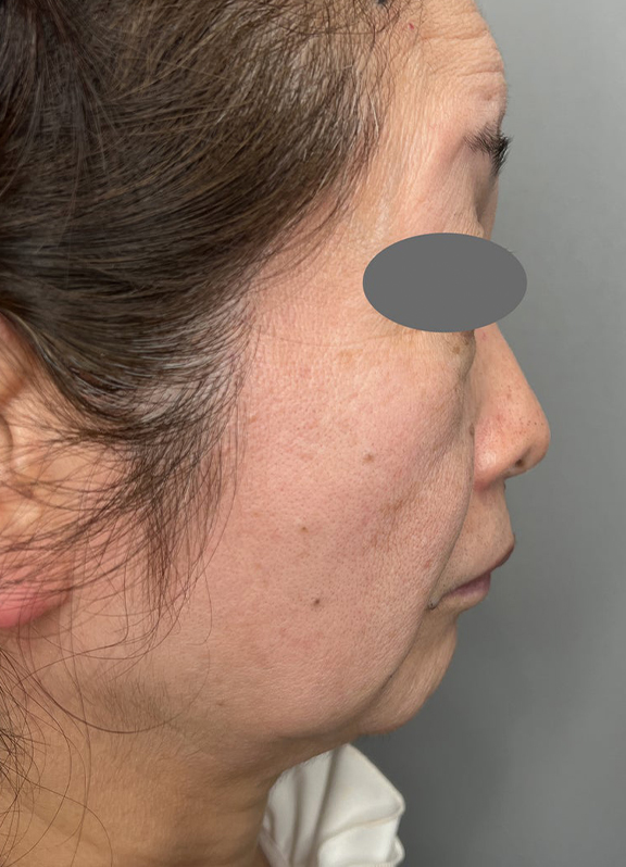 ミニフェイスリフト(頬のたるみ取り),ミニ切開リフトを行った症例写真,Before,ba_minilift022_b03.jpg