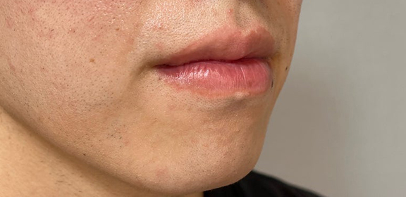 唇を薄く（口唇縮小術）,下唇を小さくした男性の症例写真,After（1ヶ月後）,ba_usuku025_a01.jpg