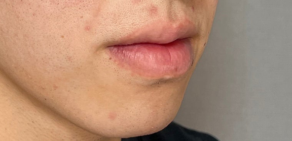 唇を薄く（口唇縮小術）,下唇を小さくした男性の症例写真,Before,ba_usuku025_b01.jpg