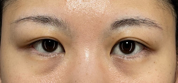 二重まぶた・全切開法,眼瞼下垂（がんけんかすい）,眼瞼下垂と二重まぶた全切開法で目の左右差を整えた症例写真,Before,ba_ganken049_b01.jpg
