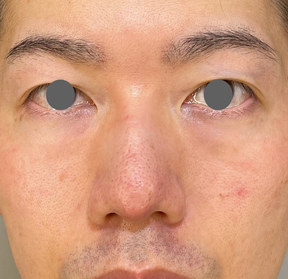 耳介軟骨移植（鼻先を出す）,耳介軟骨移植で鼻柱を下げた症例写真,After,ba_jikai055_a01.jpg