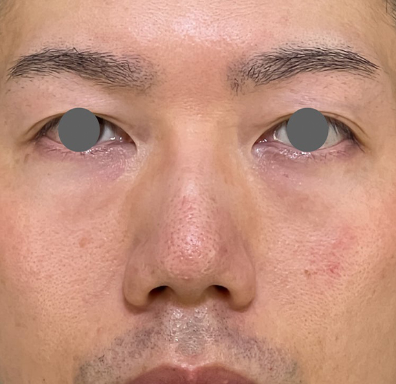 耳介軟骨移植（鼻先を出す）,耳介軟骨移植で鼻柱を下げた症例写真,Before,ba_jikai055_b01.jpg