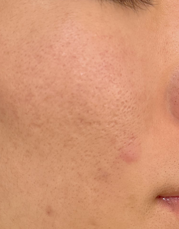 症例写真,サブシジョン+ジュベルックの症例写真,After(2ヶ月後),ba_subcision_juvelook001_b01.jpg