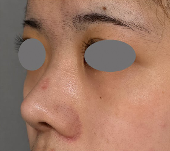 耳介軟骨移植（鼻先を出す）,耳介軟骨移植・小鼻縮小・鼻尖形成を行って洗練された印象の鼻になった症例写真,After（2ヶ月後）,ba_jikai058_b02.jpg