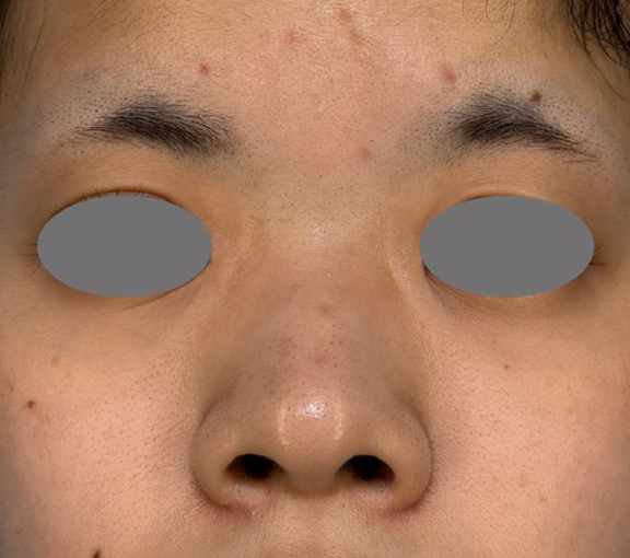 耳介軟骨移植・小鼻縮小・鼻尖形成を行って洗練された印象の鼻になった症例写真,Before,ba_jikai058_b01.jpg